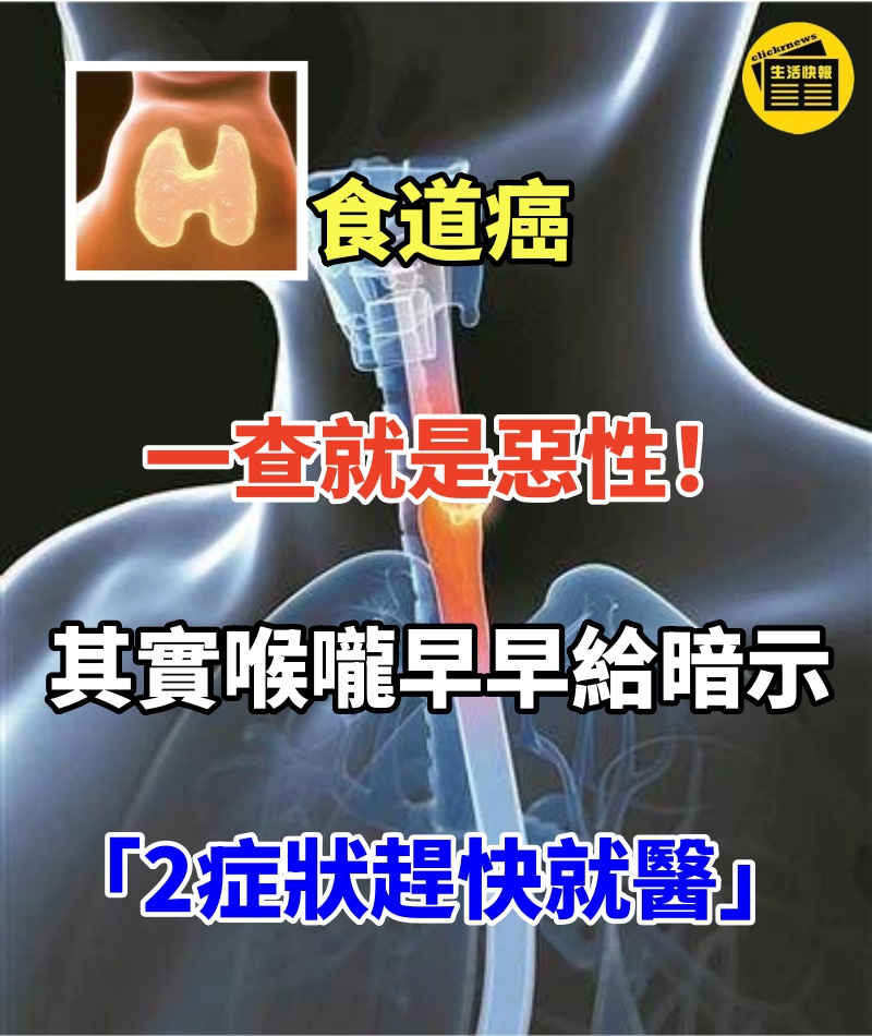 食道癌一查就是惡性!其實喉嚨早早給暗示「2症狀趕快就醫」!